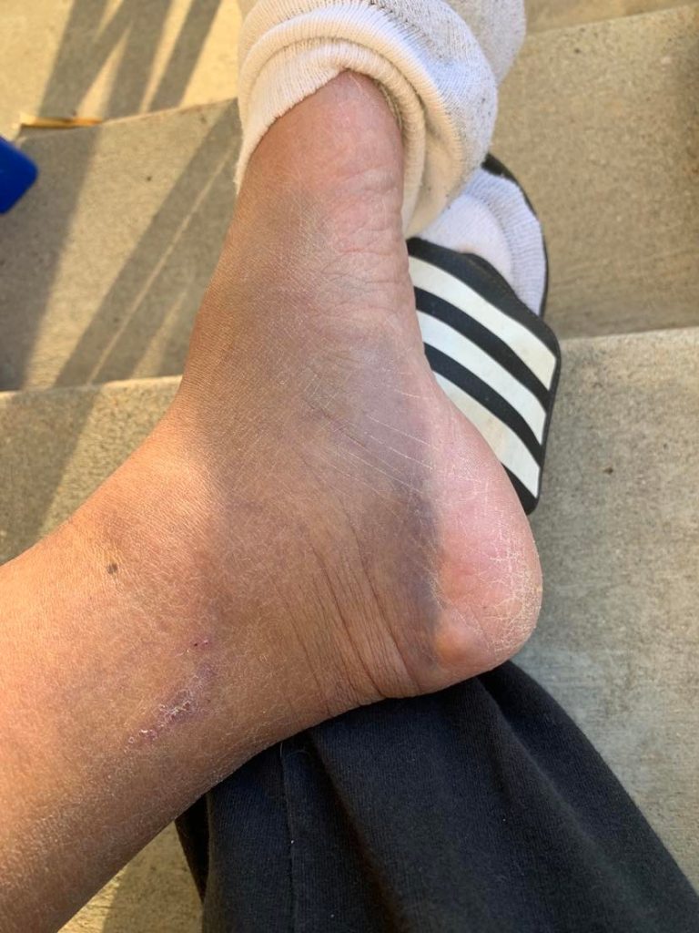 Benj Arriola's Bruised Foot with a Cyst